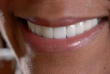dental lab veneers toronto