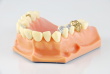 dental lab crowns toronto