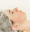 Thumbnail image for The Difference of Acne Scar Creams