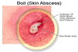 Thumbnail image for All About Skin Boils (Abcesses)