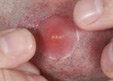 Thumbnail image for Skin Boils Pictures and Photos
