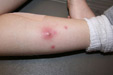 Thumbnail image for Skin Boils Symptoms and Causes